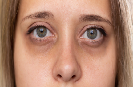 How to Reduce Dark Circles Naturally: A Complete Guide