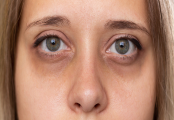 How to Reduce Dark Circles Naturally: A Complete Guide